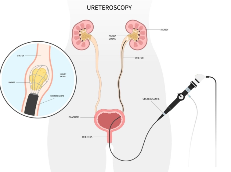 Ureteroscopy Recovery Tips Ureteroscopy Recovery Tips