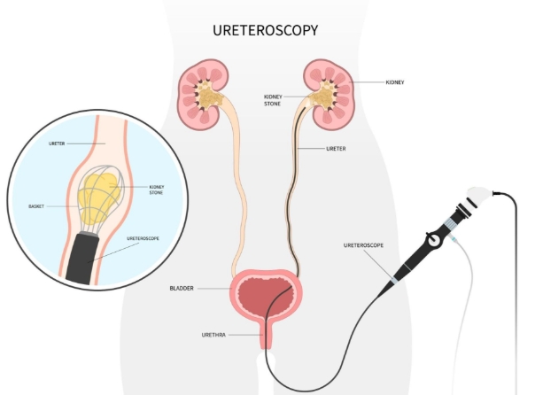 Ureteroscopy Recovery Time Ureteroscopy Recovery Time