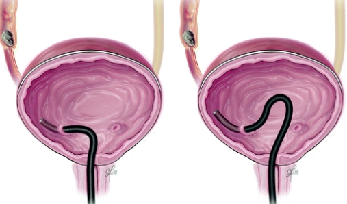 Ureteroscope Insertion Method