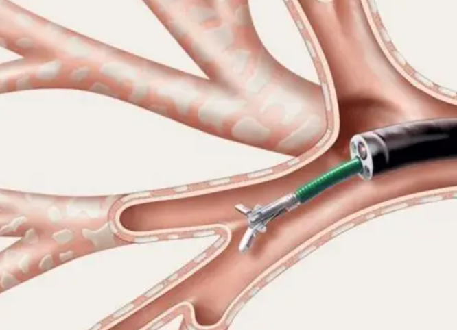 Is The Visual Examination of The Bronchi Through A Bronchoscope?
