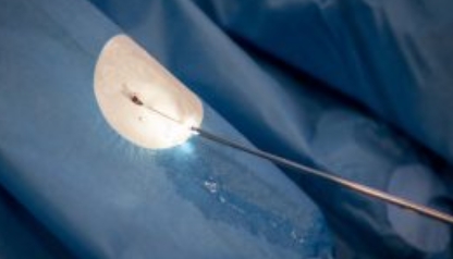 Ureteroscopy Complications And Management Ureteroscopy Complications And Management