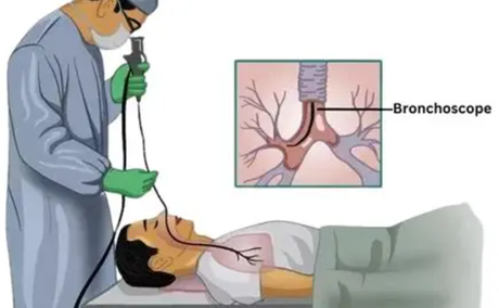 What Does Bronchoscope Was Inserted Transnasally Mean.png