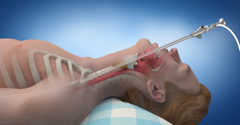 Rigid Bronchoscope Indications